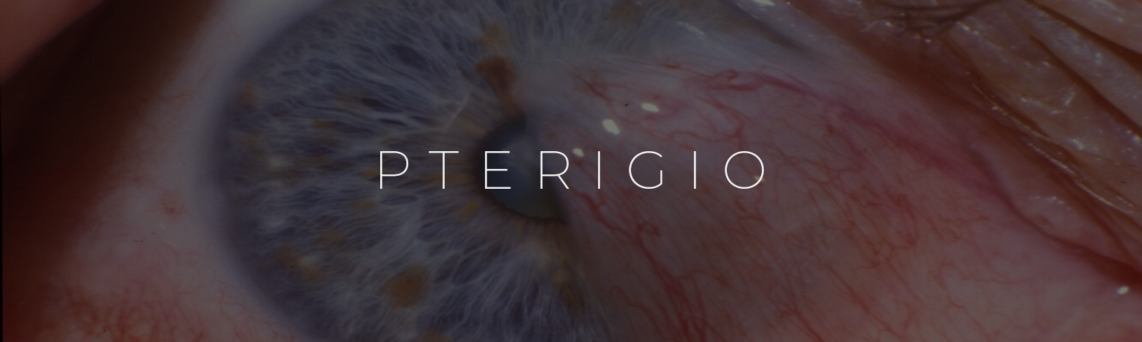 Pterigio